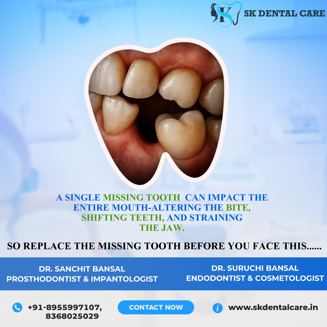 Missing Teeth Replacement